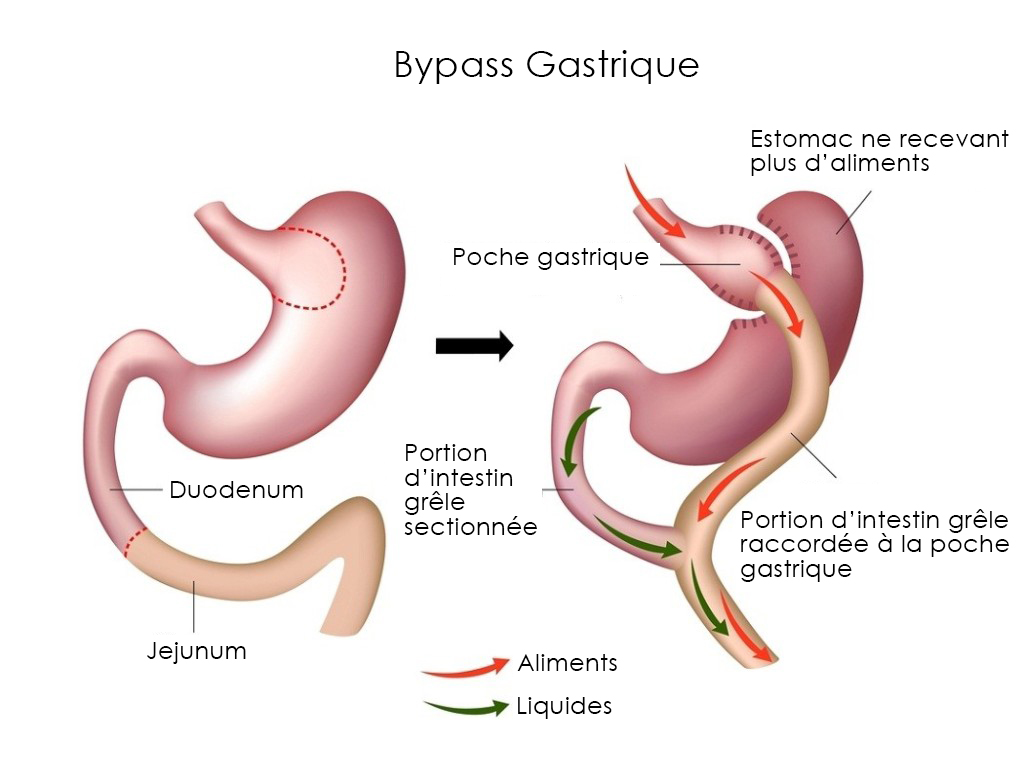 Bypass gastrique tunisie