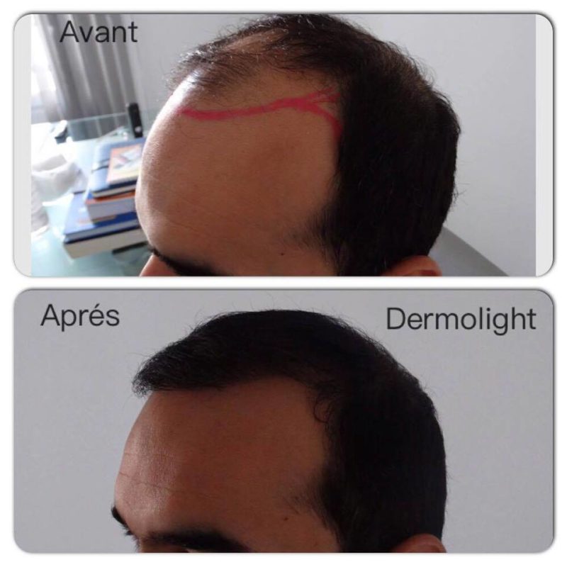 Greffe De Cheveux Tunisie Chirurgie Implant Capillaire Prix Tunisie