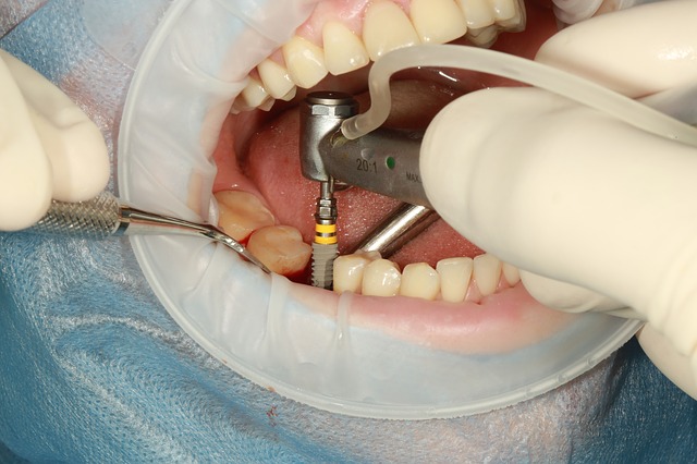 Implant dentaire Tunisie 